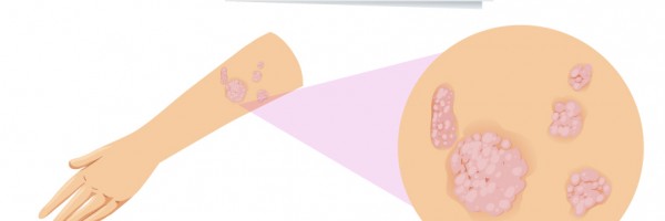 What You Should Know About Psoriatic Arthritis: Causes, Symptoms, Diagnosis, And Treatment